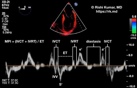 lv mpi calculator|Myocardial performance index, a Doppler.